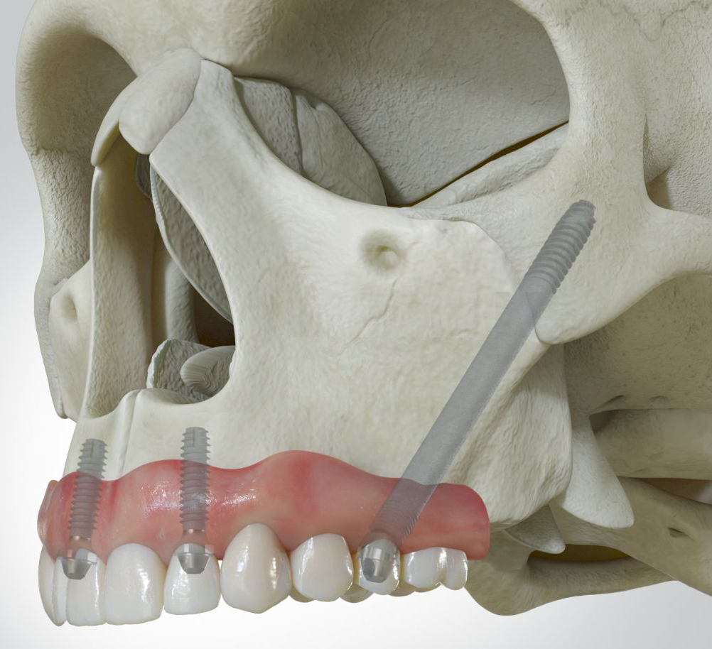 6mm to Zygomatic
