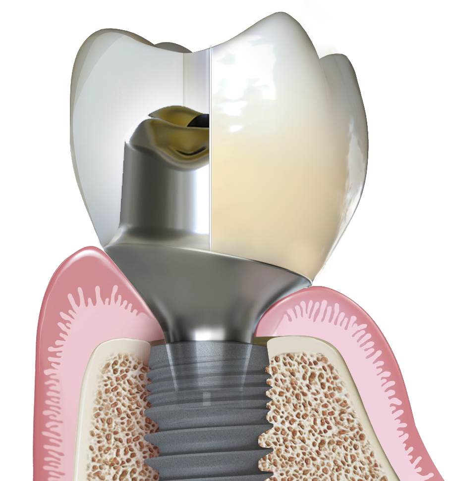 Fracture-Proof Abutments
