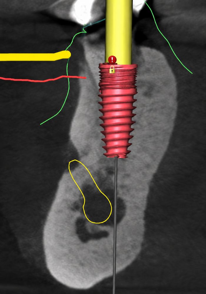BlueSkyPlan dental implant planning visualization with proximity alert and placement lock