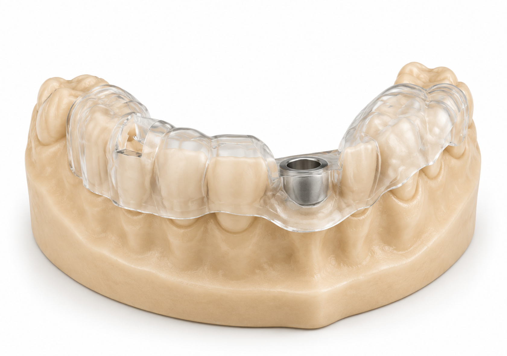 Patient-specific model and surgical guide