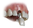 Picture of Bonded Restorationand Free Crowns (BlueSkyBio.com)