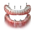 Picture of Full Arch Restorations (BlueSkyBio.com)