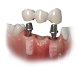 Picture of Splinted Restorations (BlueSkyBio.com)