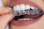 Picture of Aligners (BlueSkyBio.com)