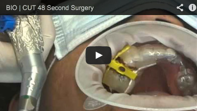 Video of a BIO | Cut 48-second Surgery